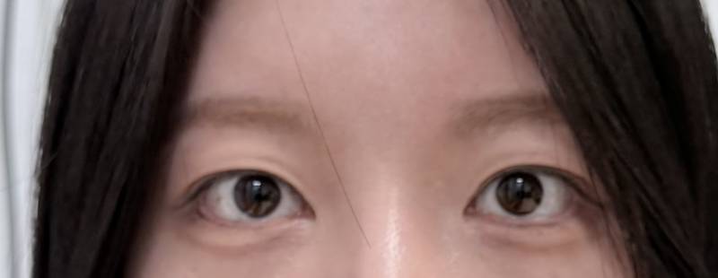 [잡담] 쌍커풀 재수술 할말... | 인스티즈