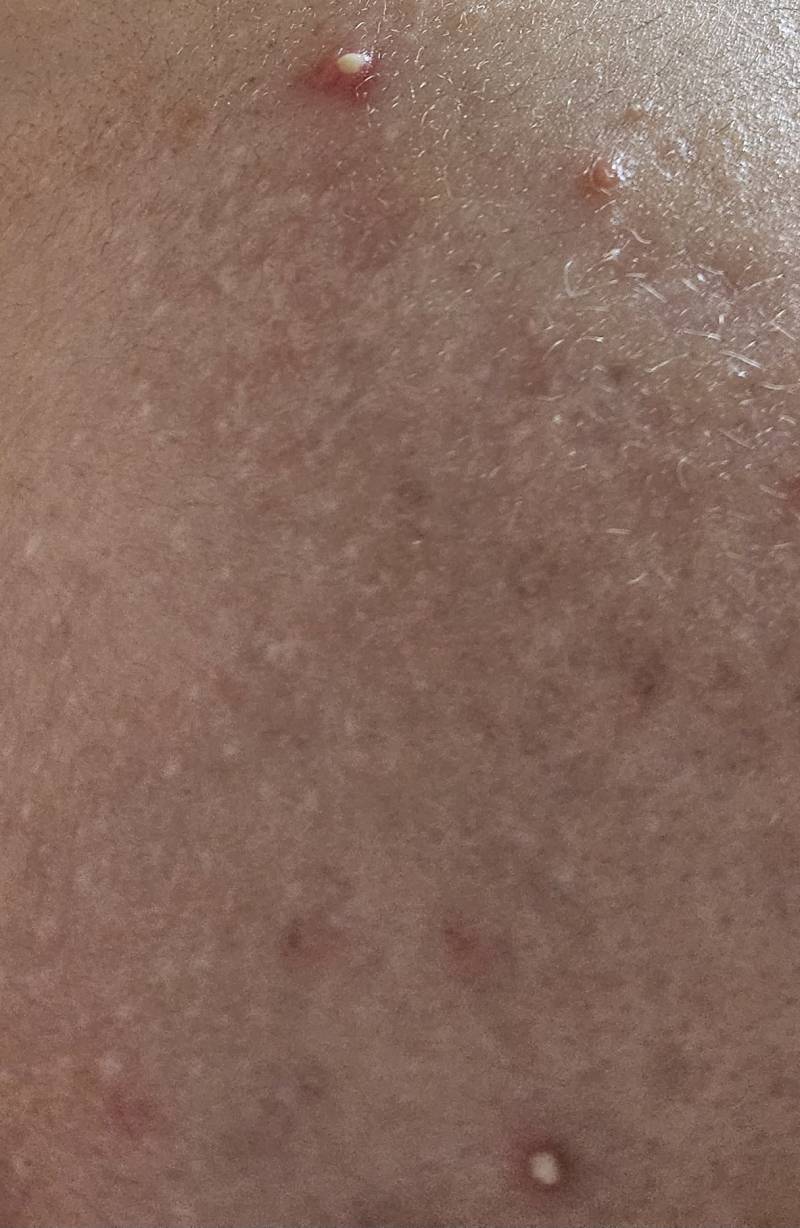 [잡담] 이거 모낭염이야? | 인스티즈