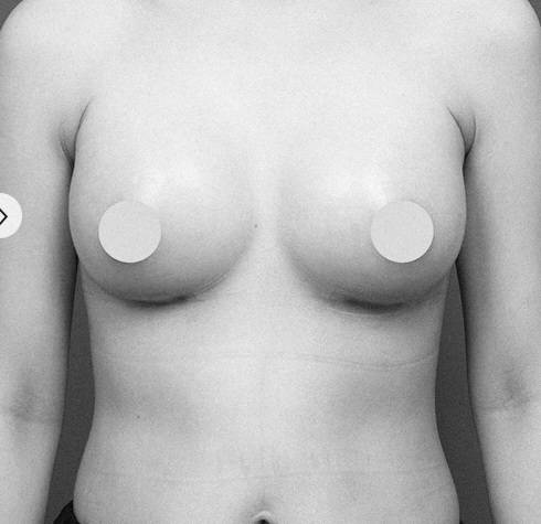 [잡담] 가슴성형 관련 궁금한거 후방주의 후방조심 | 인스티즈