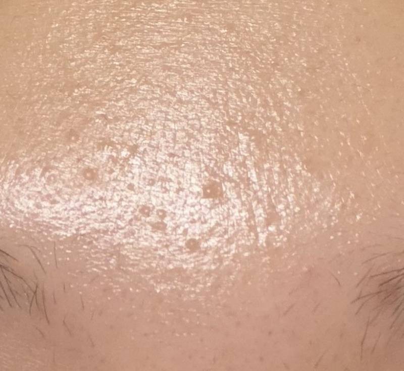 [잡담] 이마 이거 모낭염이야 좁쌀이야? | 인스티즈