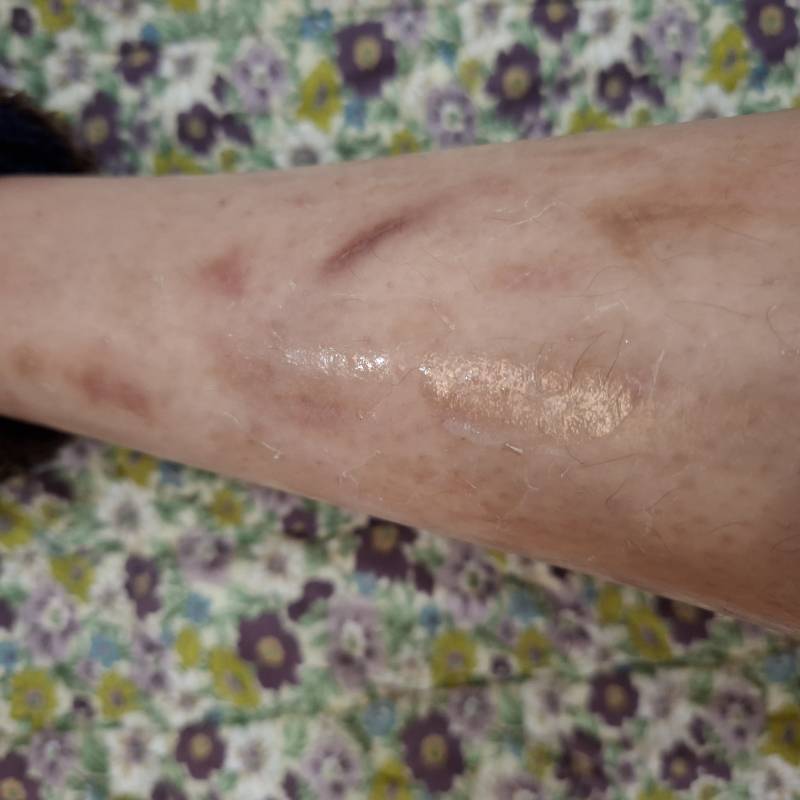 [잡담] 익들이라면 진한상처 연한상처 전부 흉터연고 바를거야? | 인스티즈