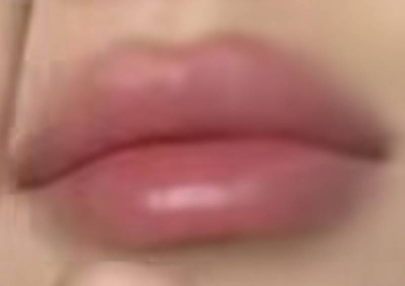 [잡담] 입술필러 후기 | 인스티즈