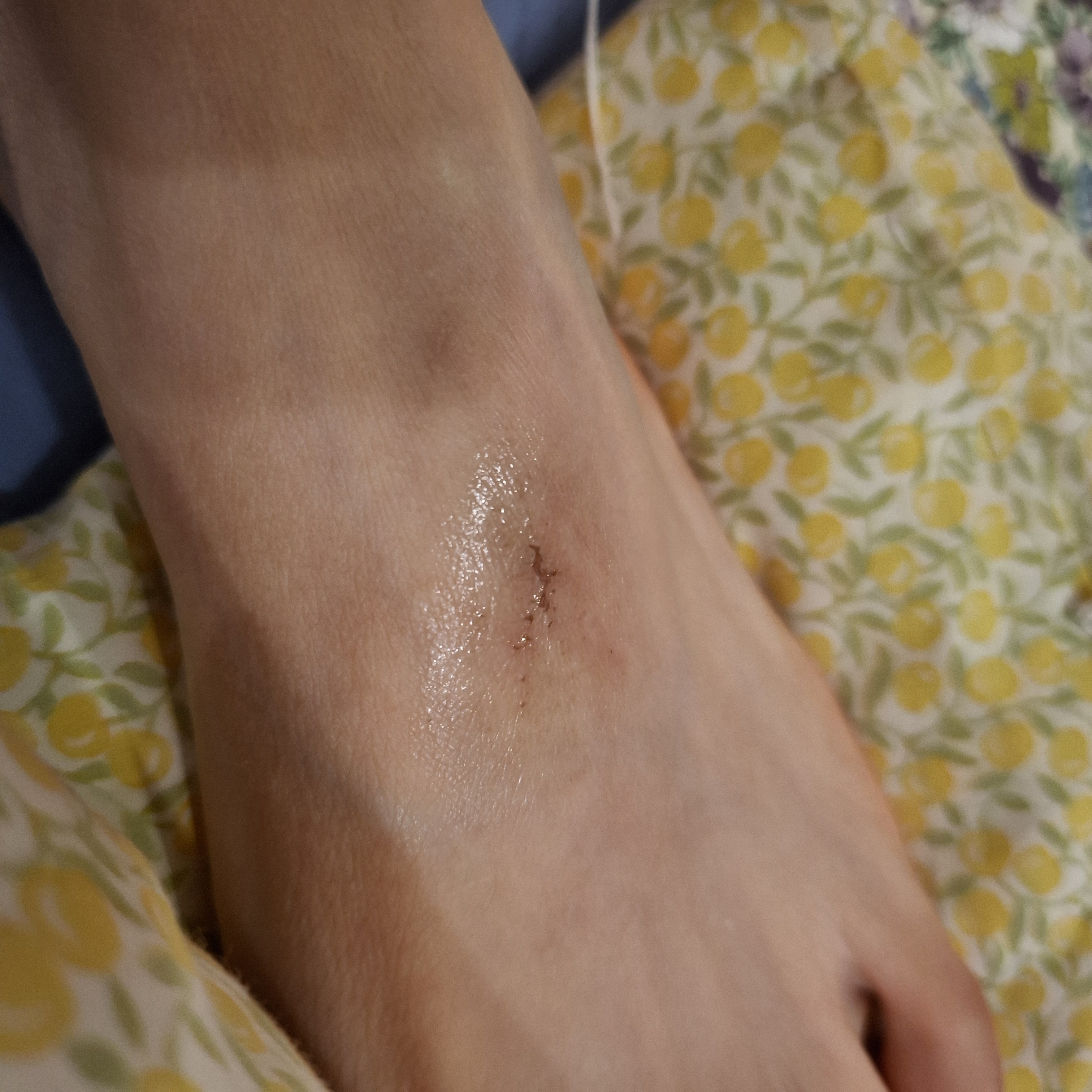 [잡담] 상처 이 정도면 마데카솔 발라? 흉터연고 발라? | 인스티즈