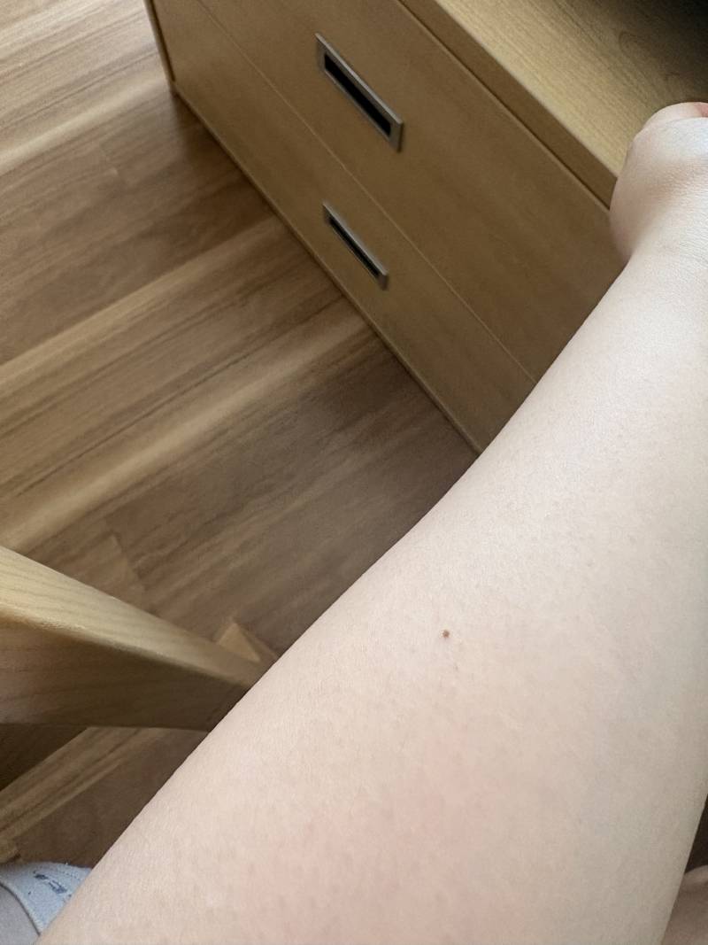 [잡담] 요만한 점 빼는데 얼마나 아포? | 인스티즈
