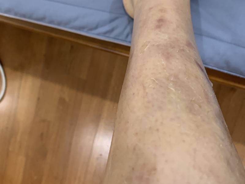 [잡담] 상처 주위에 이렇게 하얗게 껍질 벗겨지는건 왜 그런거야? | 인스티즈