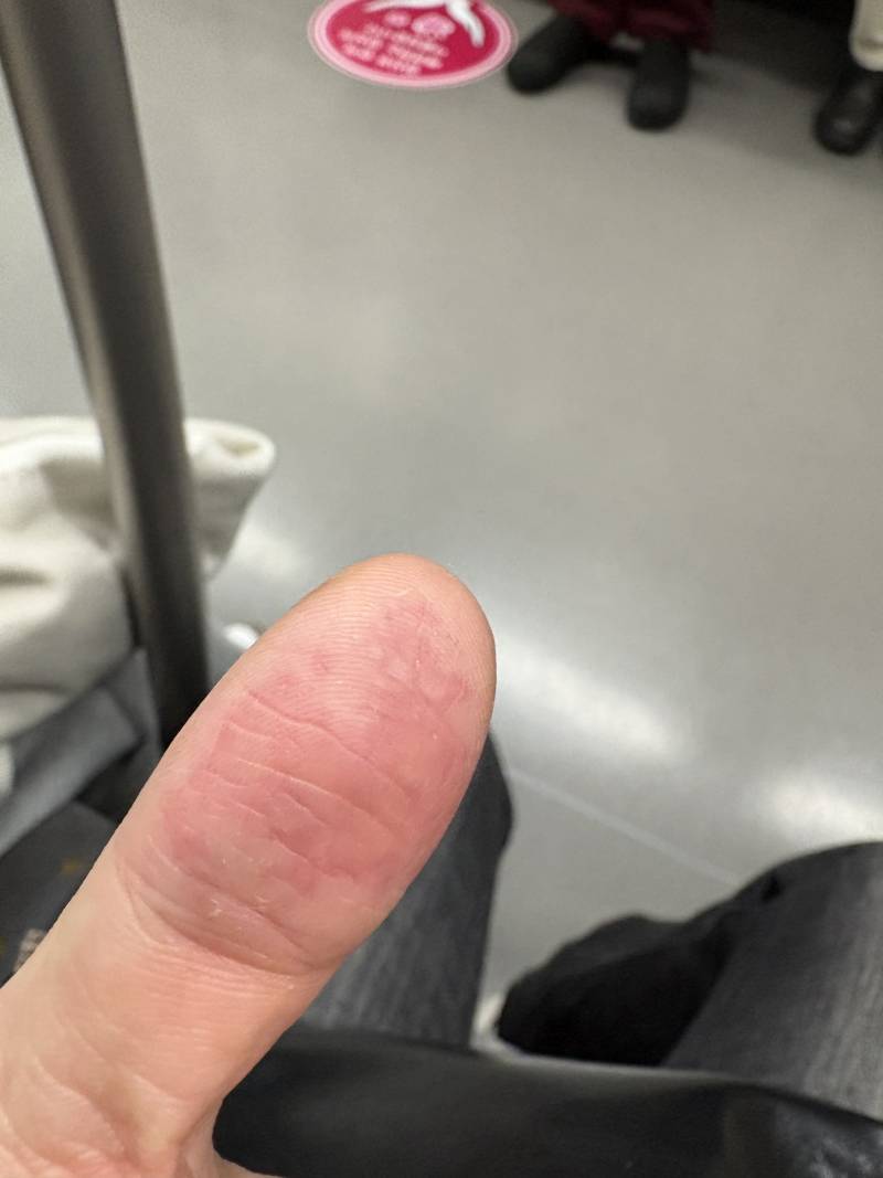 [잡담] 나 독한거안만졋는데 손가락 왜이런지 아는사람 | 인스티즈