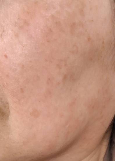 [잡담] 점 뺀지 한달 됐는데 얼굴에 자국이 많이 남는데 어떻게 해야돼? | 인스티즈