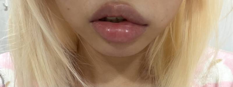 [잡담] 입술필러 최근들어 일어날때마다 부어잇는데 | 인스티즈