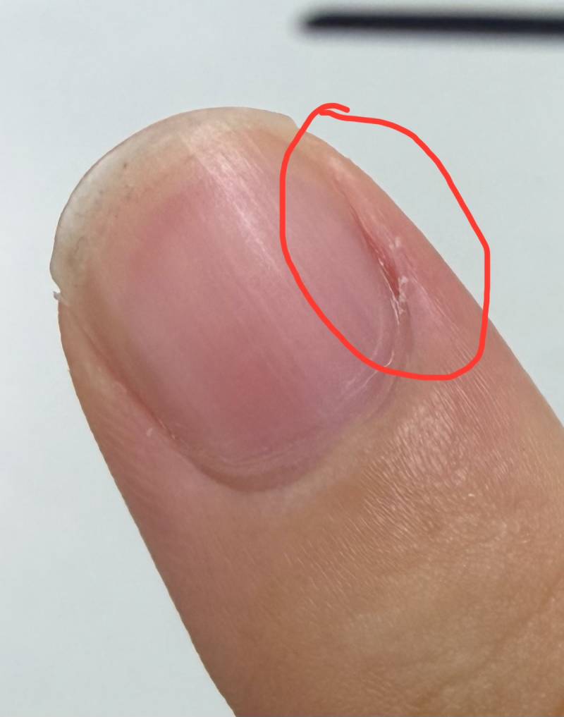 [잡담] 이쪽 손가락 옆부분 부어보여? | 인스티즈