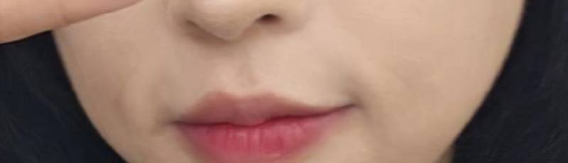 [잡담] 팔자주름 시술 뭐 받아야 될까 | 인스티즈
