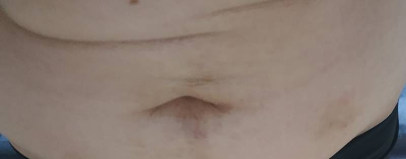 [잡담] 배 긁어댔더니 이렇게됐는데 색소침착되려나?ㅠㅠ | 인스티즈