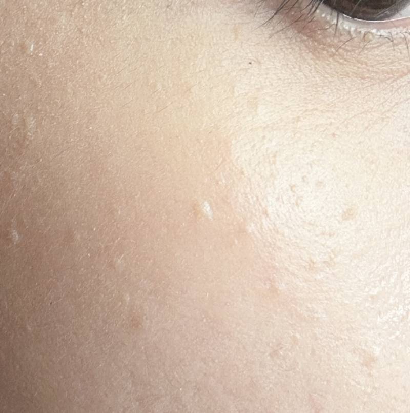[잡담] 나 편평사마귀 진짜 심하다... | 인스티즈