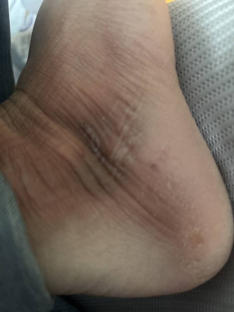 [잡담] 내 발 왜이런지 원인분석좀 | 인스티즈