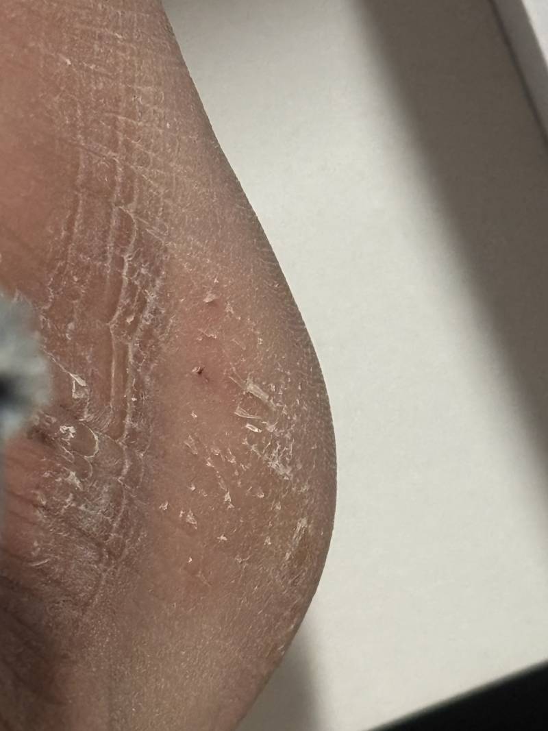 [잡담] 피부과 가믄 하루만에 낫게해줌? | 인스티즈