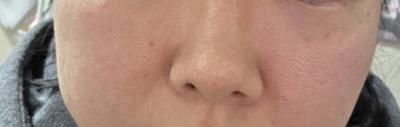 [잡담] 나 피부과 시술 추천 좀 | 인스티즈