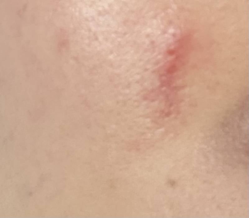 [잡담] 볼 흉터 이거 오래갈까? | 인스티즈
