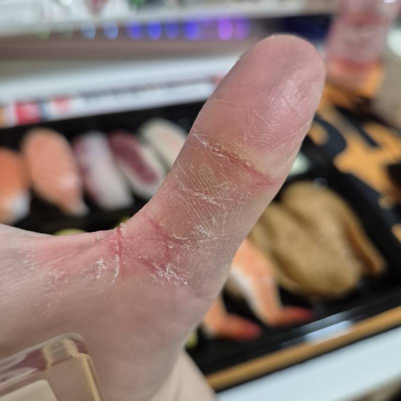 [잡담] 손 건조 해서 다 갈라짐 | 인스티즈
