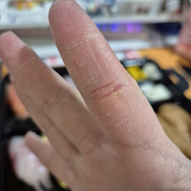 [잡담] 손 건조 해서 다 갈라짐 | 인스티즈