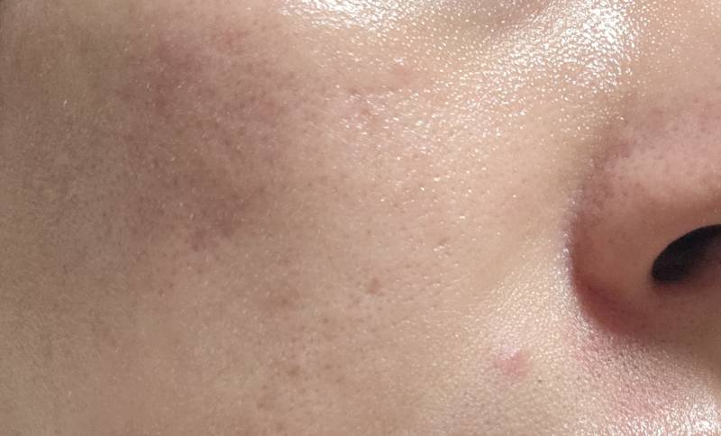 [잡담] 피부과 잘 아는 익들 있나...? 나 이런피부는 어떤 치료 받아야해? (약혐주의) | 인스티즈