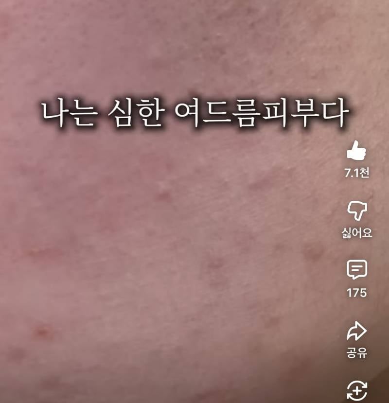 [잡담] 이런 피부도 피부과가면 약처방해줘? | 인스티즈