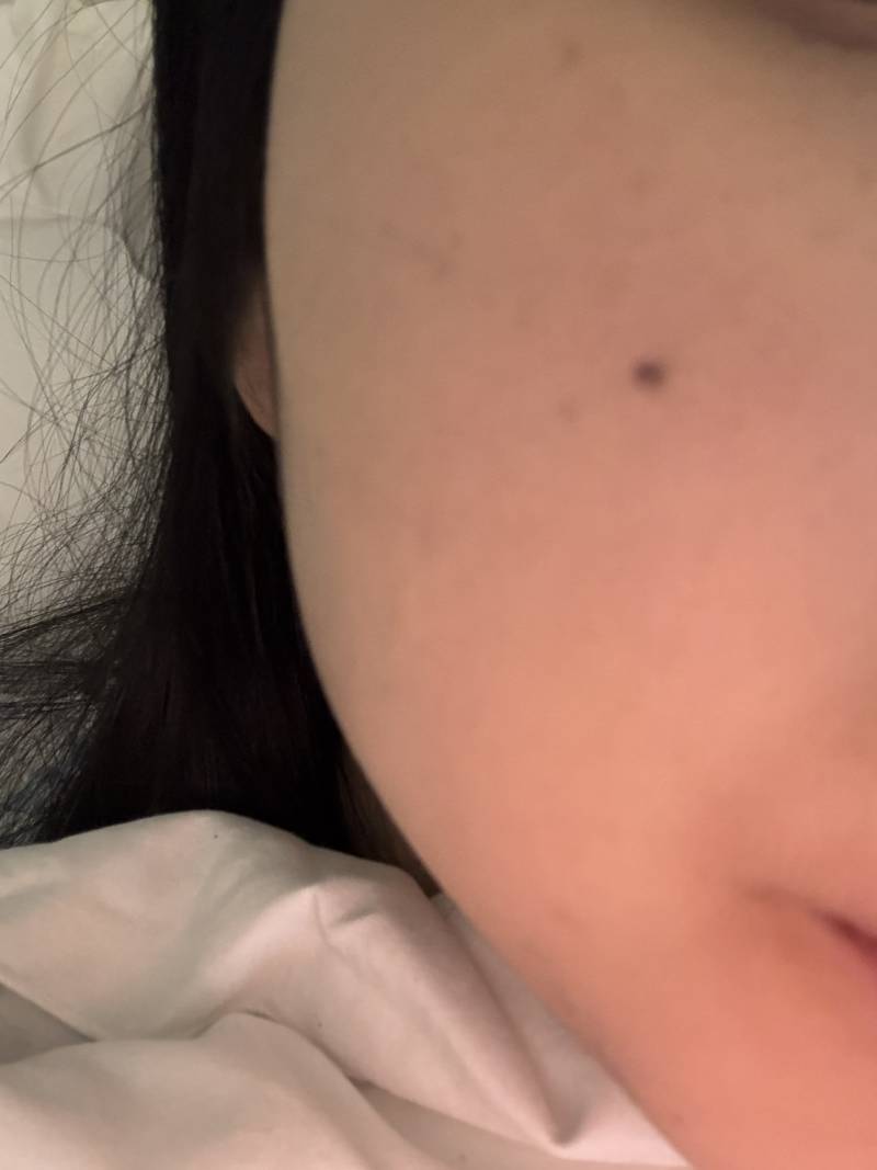 [잡담] 얼굴 점 이정도 크기면 레이저 몇번 받아야할까 | 인스티즈