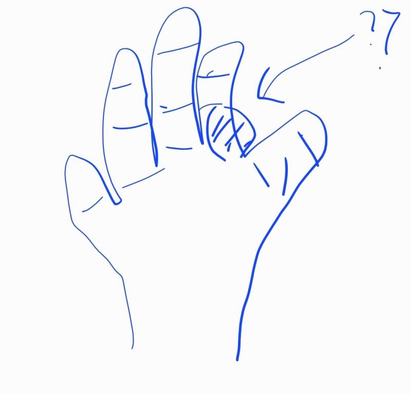 [잡담] 나 손 잘못된건가? 다친건가?? | 인스티즈