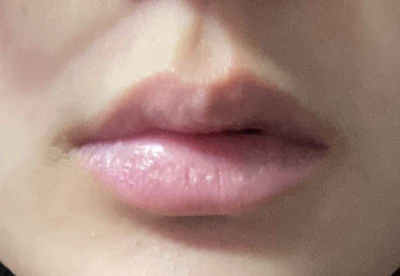 [잡담] 입술 어때?? 필러할까?? | 인스티즈