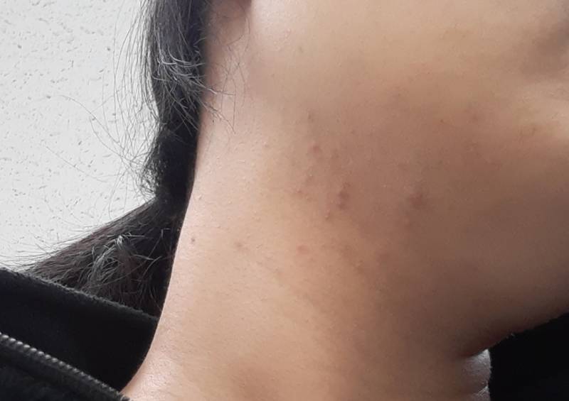 [잡담] 이런 여드름 어떻게 없애??ㅠㅠㅠ 도와줘 ㅠㅠ | 인스티즈