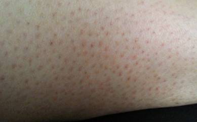 [잡담] 닭살 피부 (모공각화증?) 있던 익들 어떻게 없어졌어?? | 인스티즈