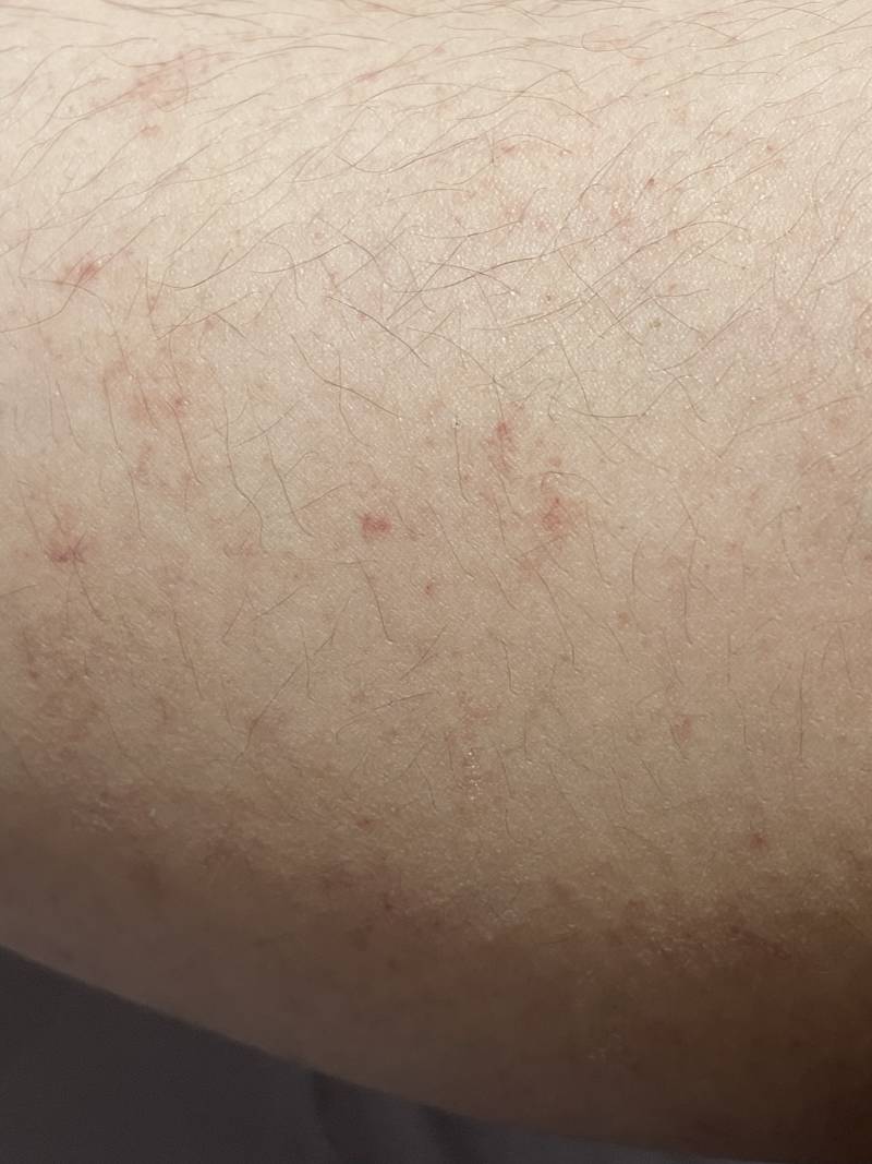 [잡담] 피부에 이런거 나는데 이거 뭕 아는 사람 급함 | 인스티즈