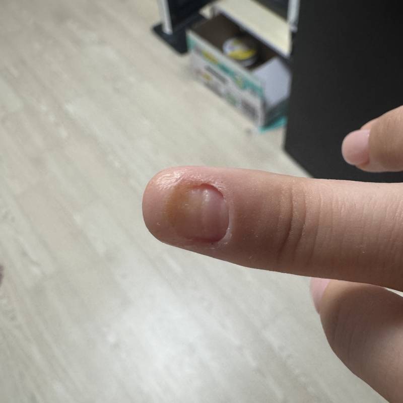 [잡담] 이런 경우도 손톱이 다시 자라나? | 인스티즈