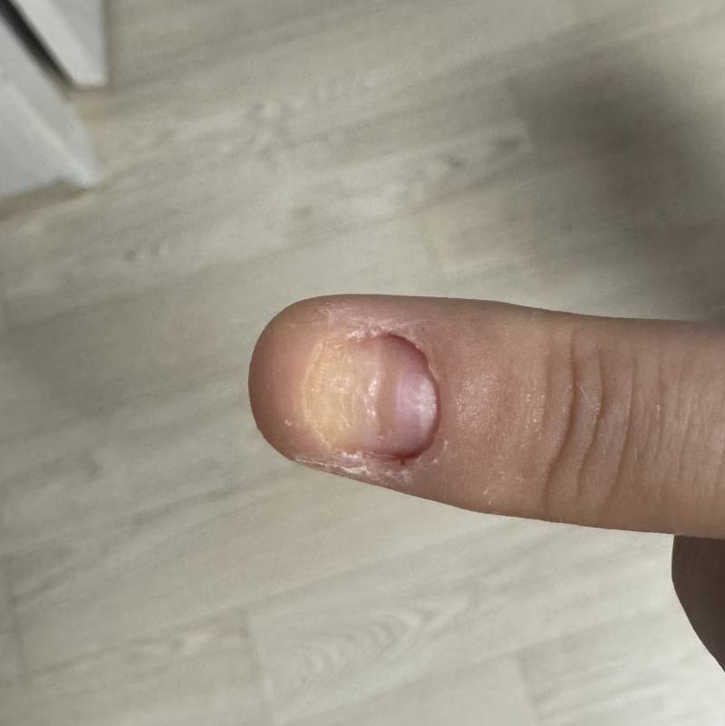 [잡담] 이런 경우도 손톱이 다시 자라나? | 인스티즈