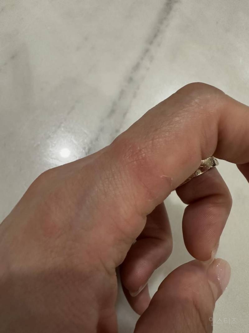 샤넬 반지 끼고 습진 생긴 사람들.thread | 인스티즈