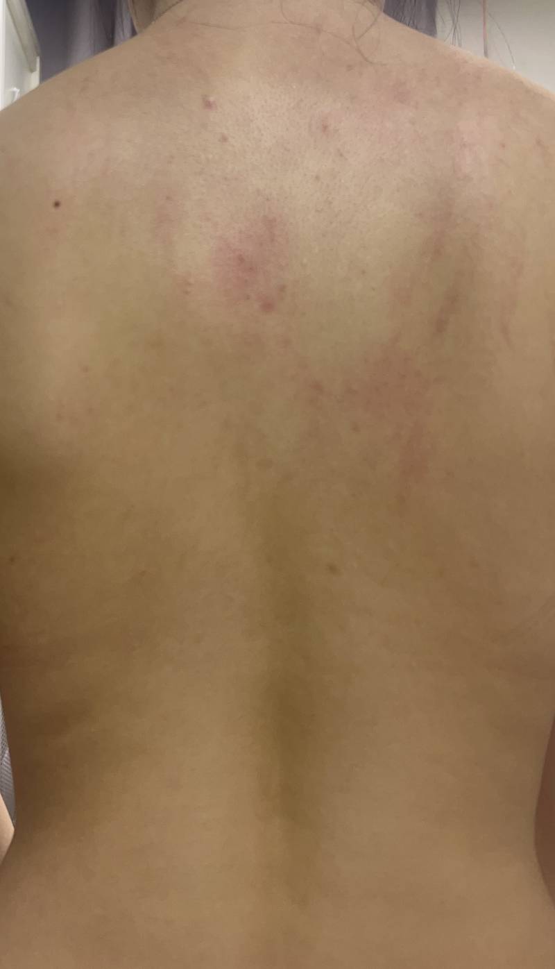 [잡담] 등드름 많이 심해? 이거 대체 어카냐ㅜㅜ (ㅎㅇㅈㅇ) | 인스티즈