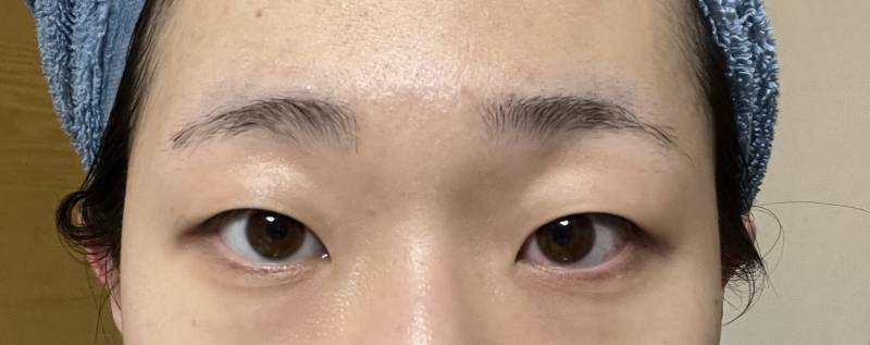 [잡담] 나 쌍수 상담받고 왔는데 고민된다 ㅜ 후기좀 봐줘 | 인스티즈