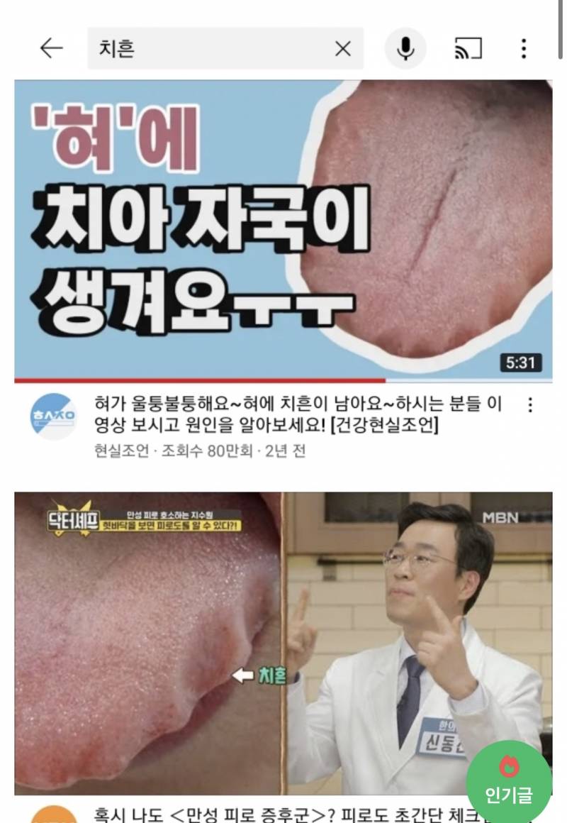 [잡담] 혀가 울퉁불퉁한거 건강 안 좋은거야? | 인스티즈