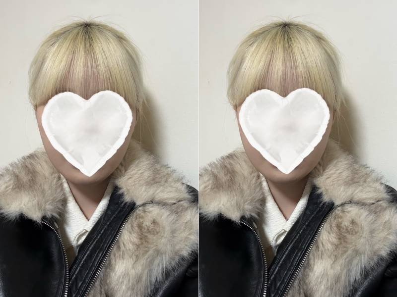 [잡담] 얘들아 안면윤곽하면 이정도는 가능이지?? | 인스티즈