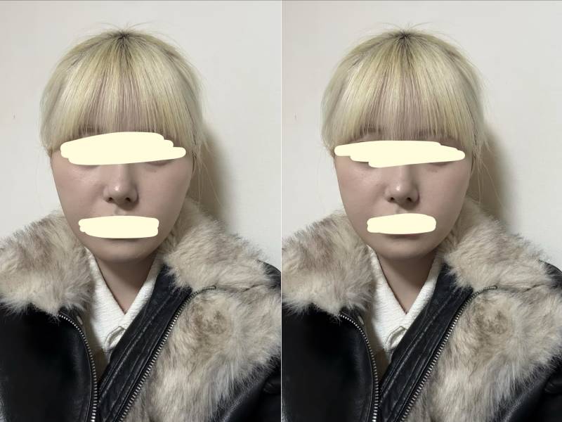 [잡담] 얘들아 안면윤곽하면 이정도는 가능이지?? | 인스티즈