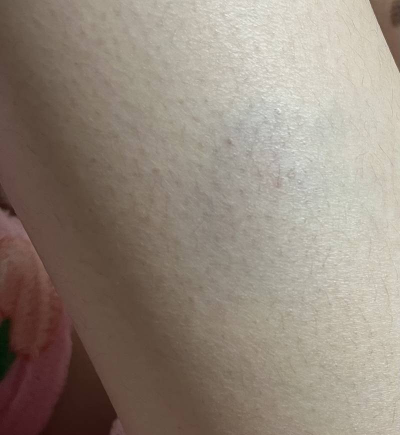 [잡담] 2시간전에 멍든건데 걸을때마다 아파ㅋㅋㅋㅋ큐ㅠㅠ | 인스티즈