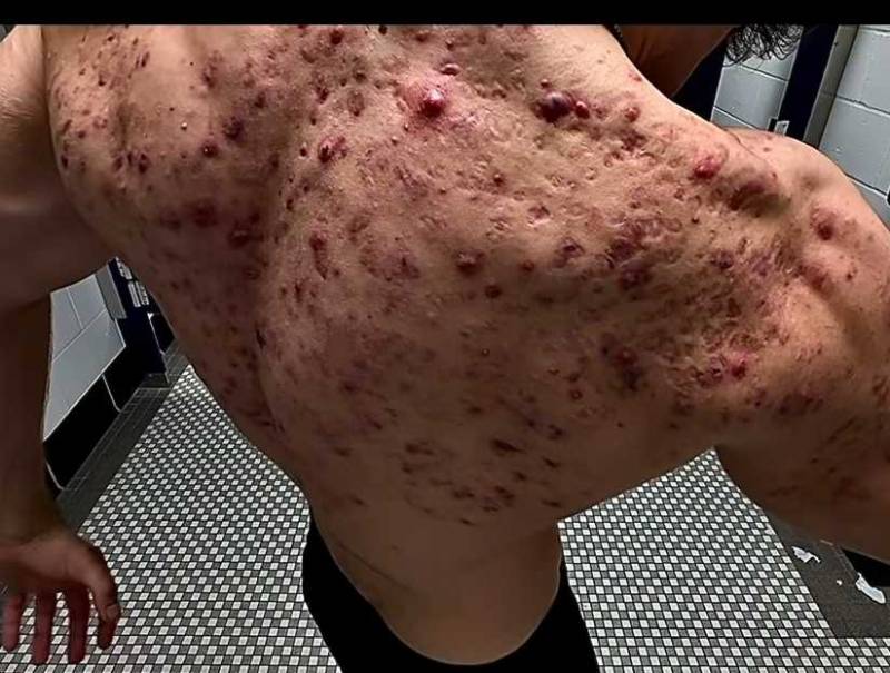 [잡담] (혐오주의) 운동하는 남자들중 약물로 근육 키우면 이렇게 됨 | 인스티즈