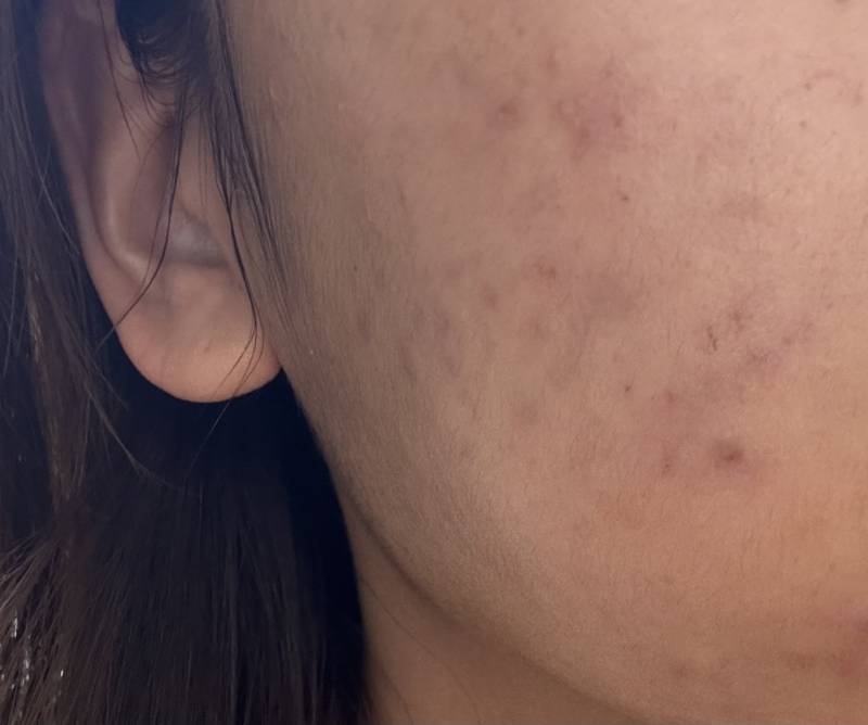 [잡담] 여드름 흉터 엑셀브이 완전 추천해 | 인스티즈