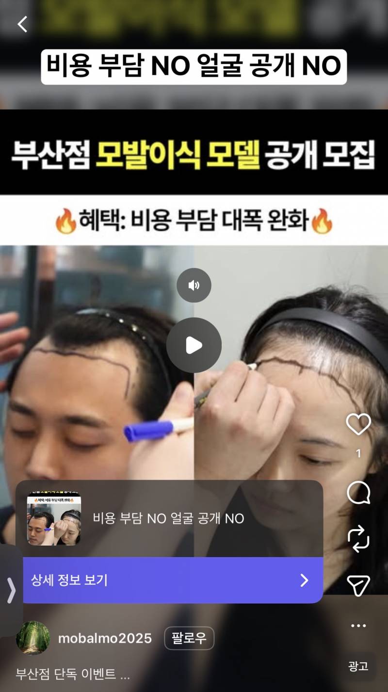 [잡담] 인스타에 이런 모발이식 이벤트 참여해도 괜찮은 건가? | 인스티즈