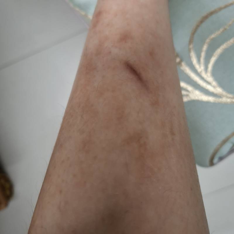 [잡담] 흉터 이렇게 있으면 흉터연고 전체적으로 바를거야? 흉터진한 부분에만 바를거야? | 인스티즈