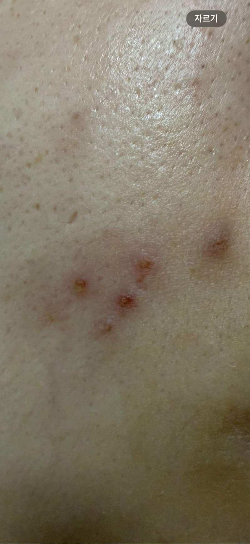 [잡담] 압출하고 노랗게 좀 올라왔는데 어캐? | 인스티즈