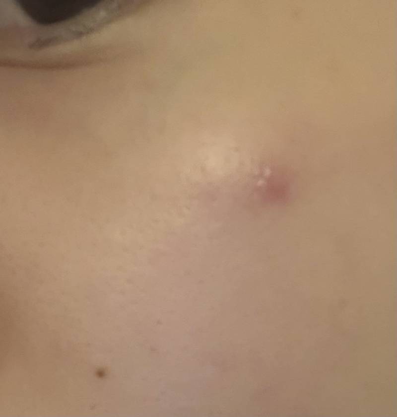 [잡담] 이런 벌레 물린것 같은 여드름 아는 사람 | 인스티즈