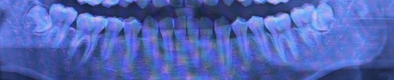 [잡담] 이거 매복사랑니지 40 | 인스티즈