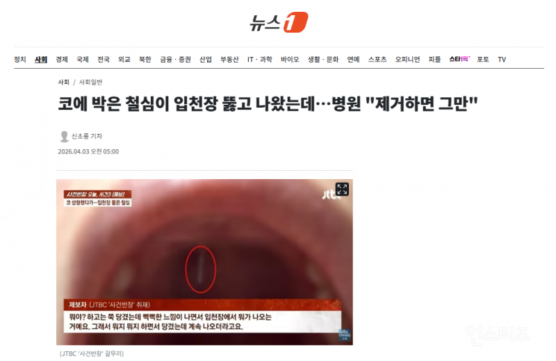 코에 박은 철심이 입천장 뚫고 나왔는데…병원 "제거하면 그만" | 인스티즈