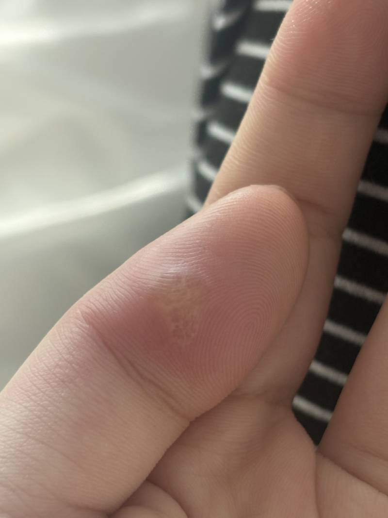 [잡담] 이거 사마귀인가? ㅠㅠ | 인스티즈