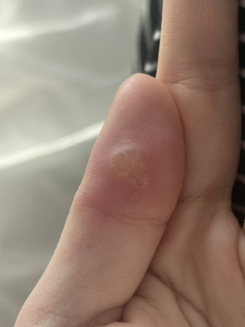 [잡담] 이거 사마귀인가? ㅠㅠ | 인스티즈
