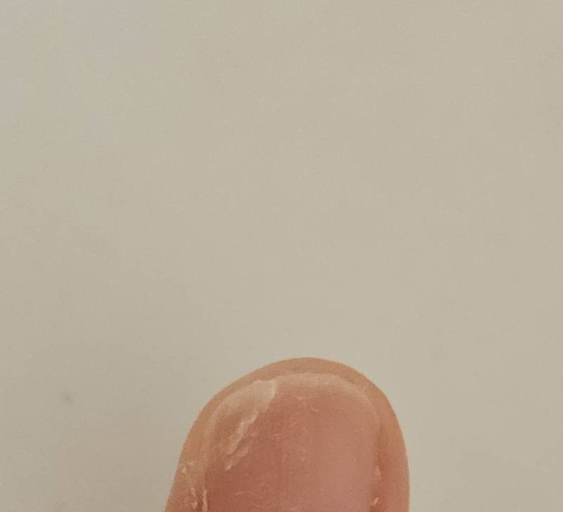 [잡담] 손톱 사선으로 갈라졌는데... | 인스티즈